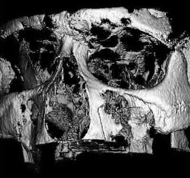 Röntgenbild Kieferbruch
